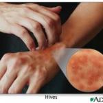 What Is Hives Allergies?