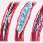 Drugs Proved To Be More Effective In Preventing Second Strokes